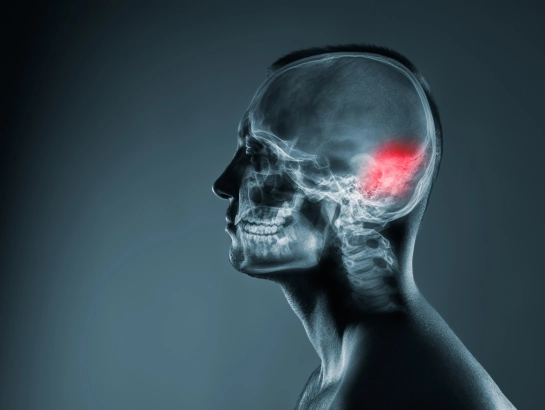 brain-stroke-Treatment